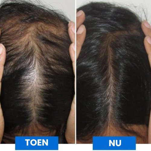 NeuroSoothe™ I Slimme hoofdhuidmassage