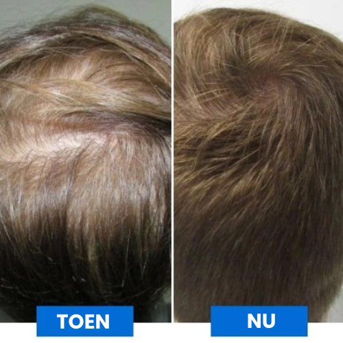 NeuroSoothe™ I Slimme hoofdhuidmassage
